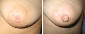 Photos before and after Nipple Correction/Areola correction 5