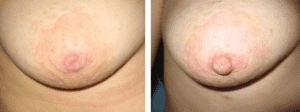 Photos before and after Nipple Correction/Areola correction 6