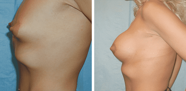 Фото до и после Тубулярная грудь 3