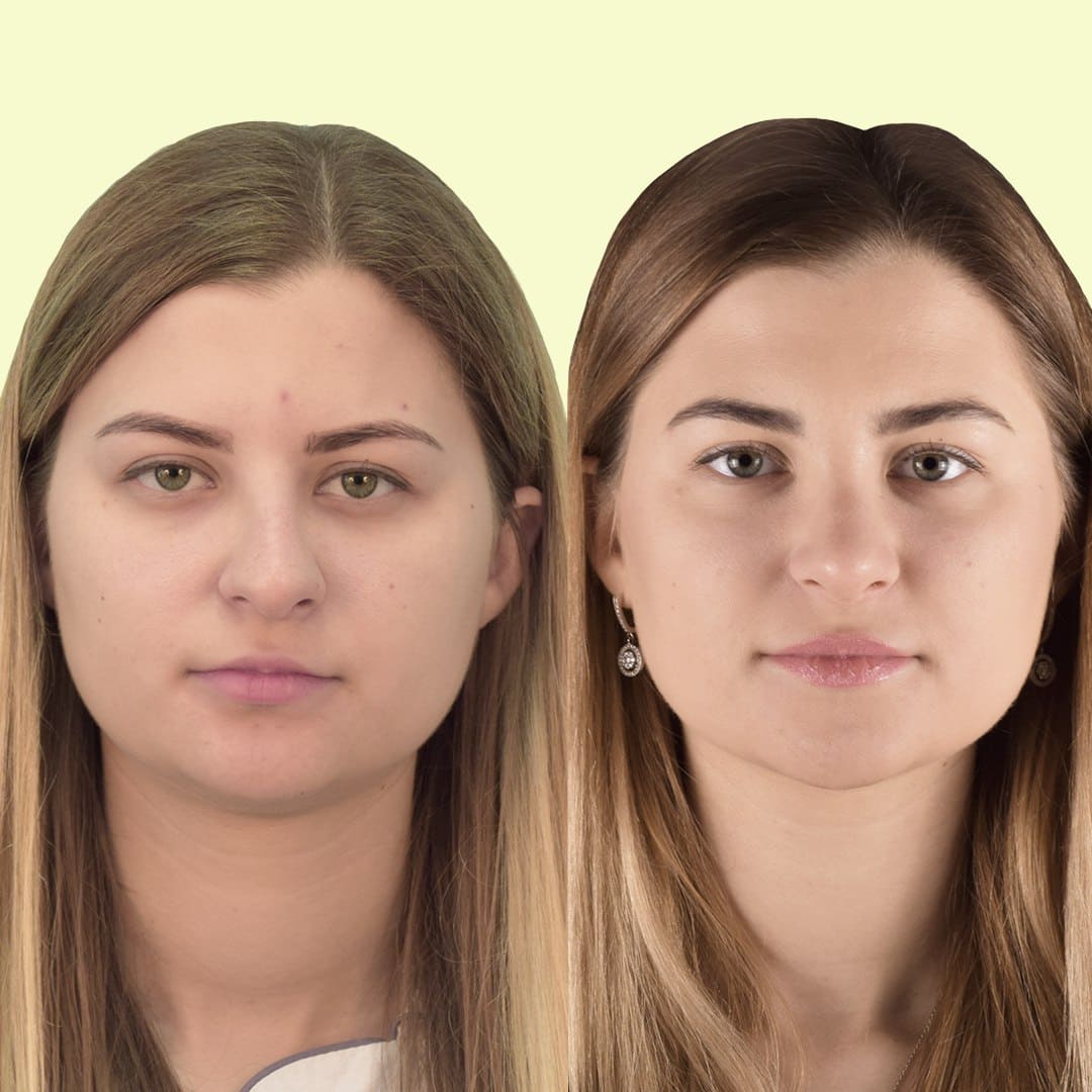Фото до та після Ринопластика (пластика носа) 18