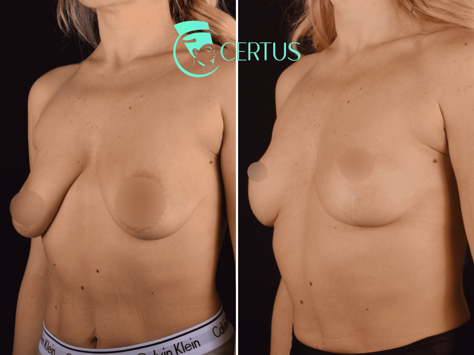 Фото до и после Подтяжка груди (мастопексия) 1