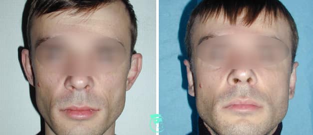 Фото до та після Пластика вух 11