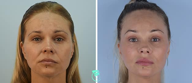 Фото до та після Підтяжка обличчя 23