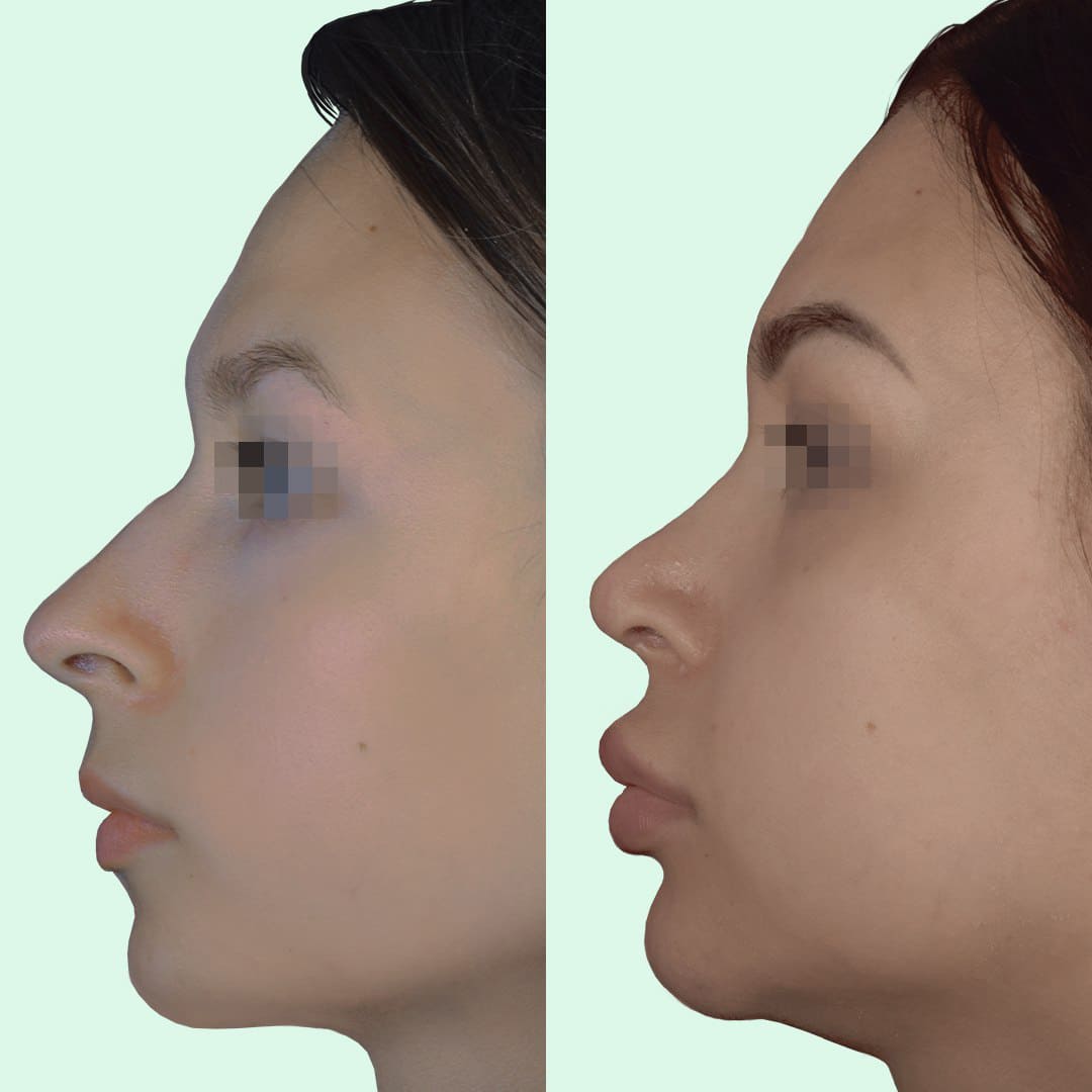 Фото до та після Ринопластика (пластика носа) 15