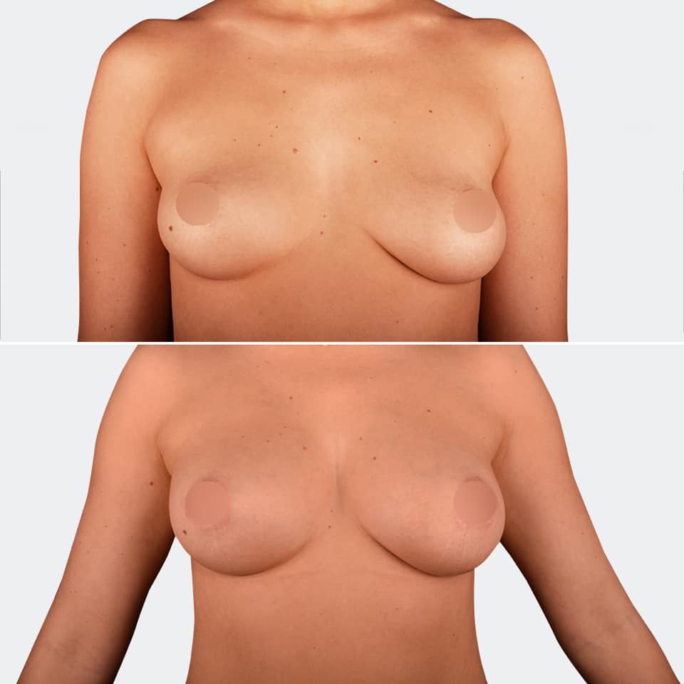 Фото до и после Липофилинг груди 1