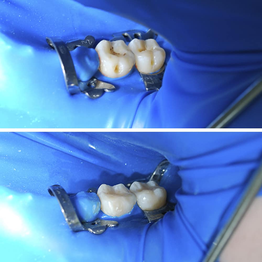 Photos before and after Therapeutic dentistry 1