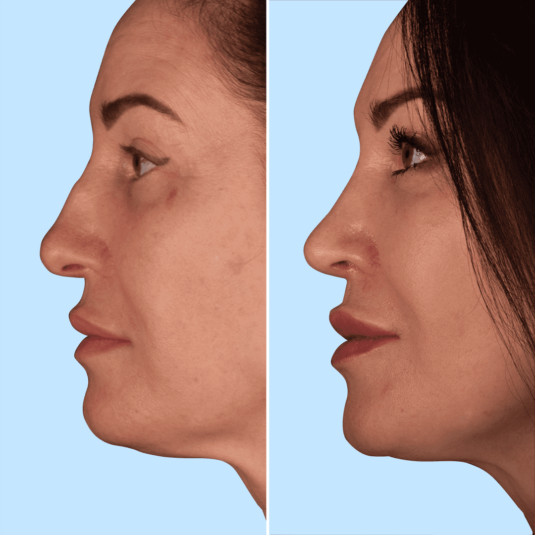 Фото до та після Ринопластика (пластика носа) 13