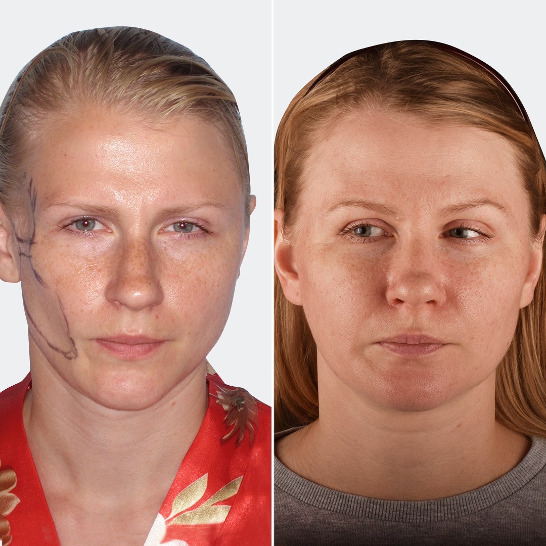 Фото до та після Ліпофілінг обличчя 1