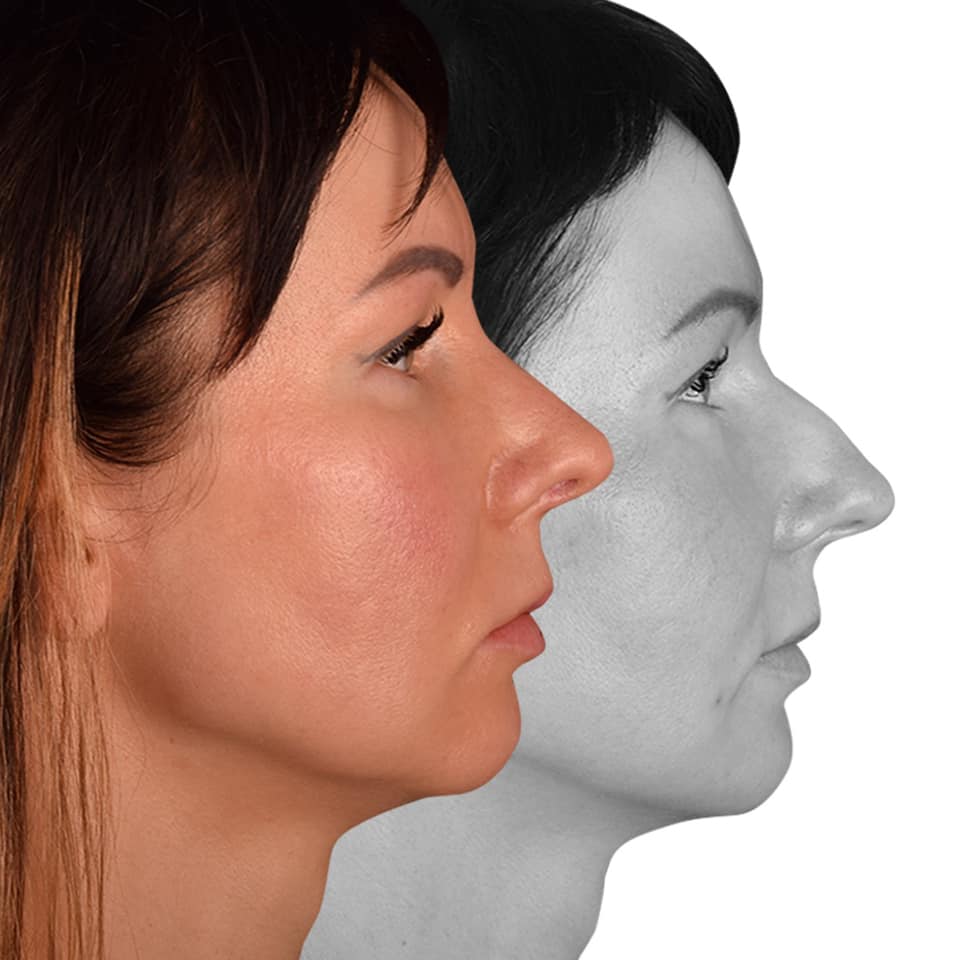 Фото до и после Ринопластика (пластика носа) 1