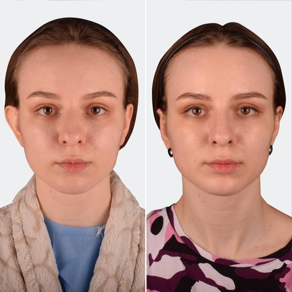 Фото до та після Пластика вух 1