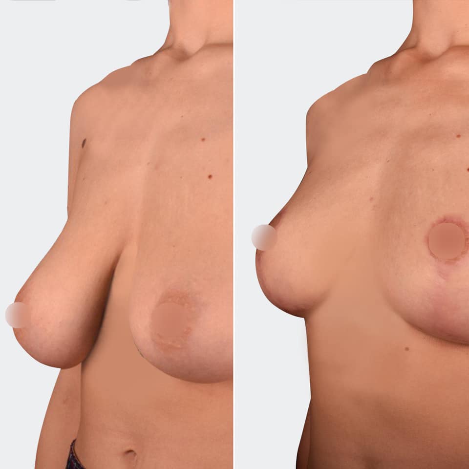 Фото до и после Уменьшение груди 1
