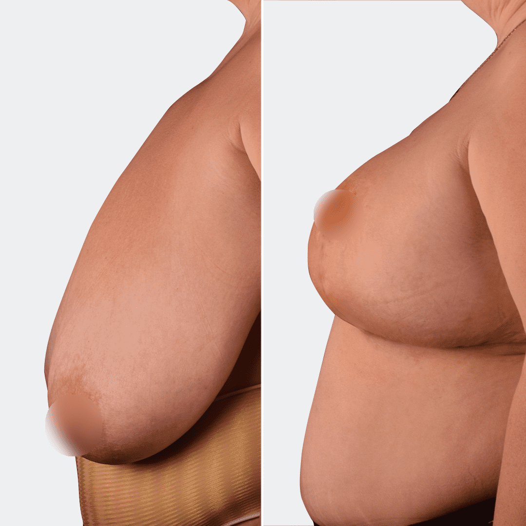 Фото до и после Подтяжка груди (мастопексия) 2