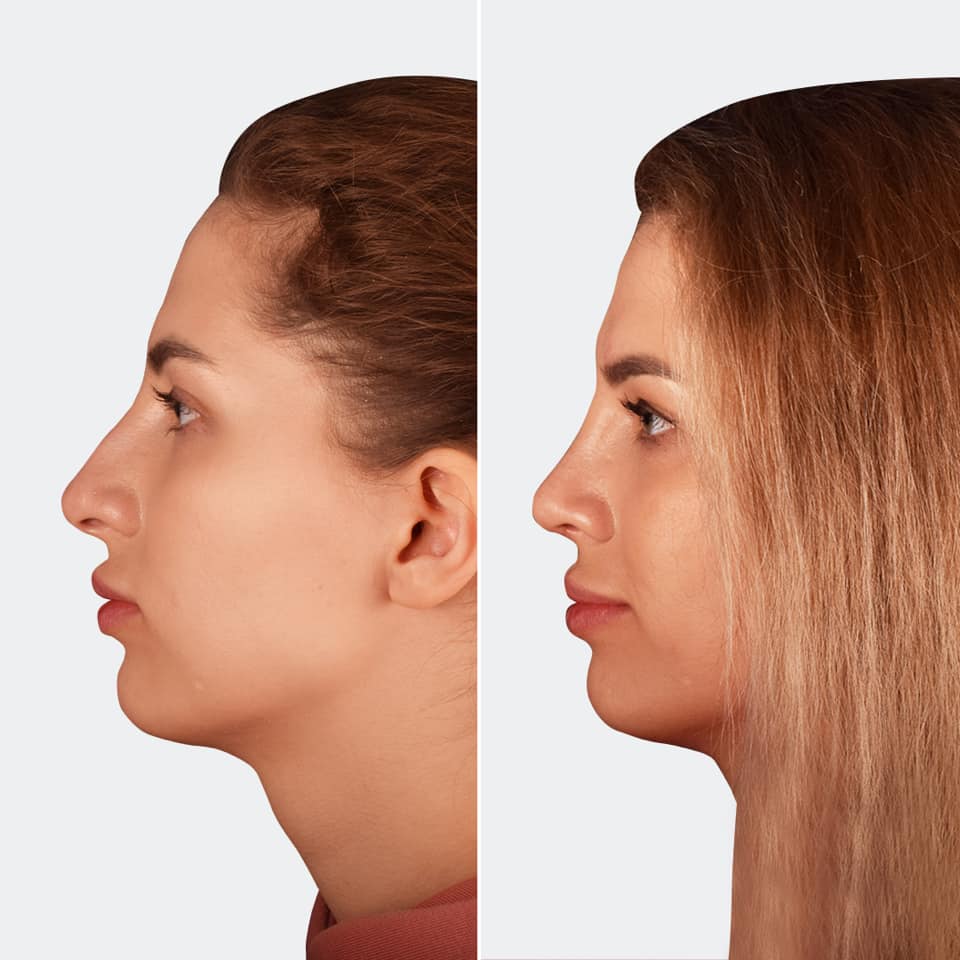 Фото до та після Ринопластика (пластика носа) 11