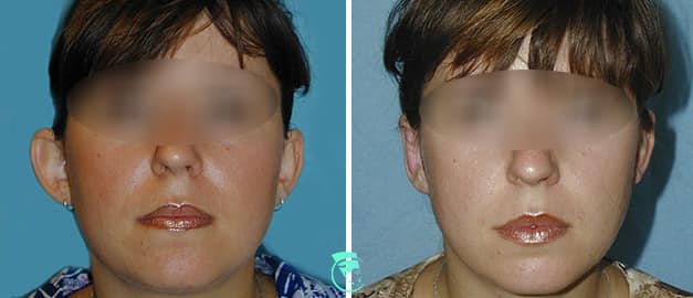 Фото до та після Пластика вух 21