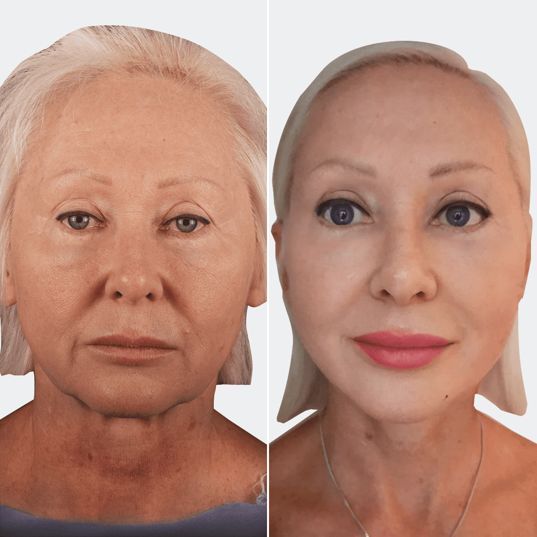 Фото до та після Підтяжка обличчя 17