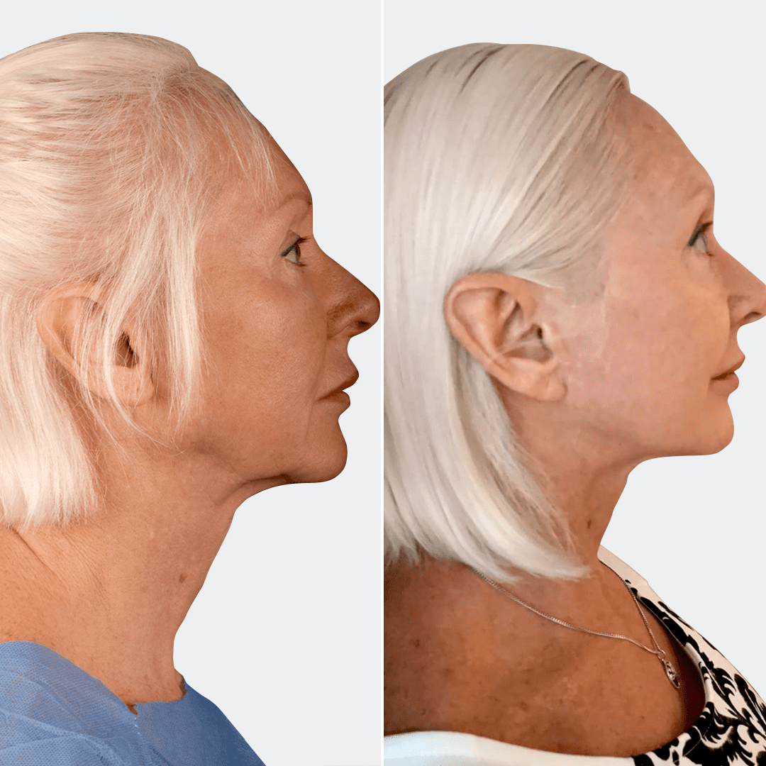 Фото до и после Подтяжка лица 16