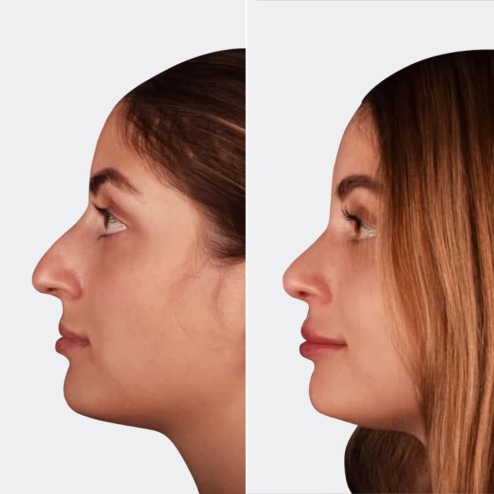 Фото до и после Ринопластика (пластика носа) 12