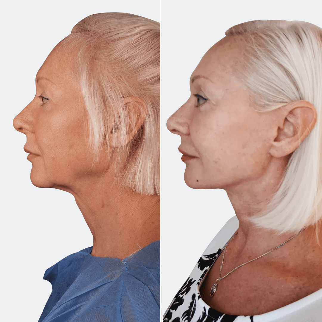 Фото до та після Підтяжка обличчя 18