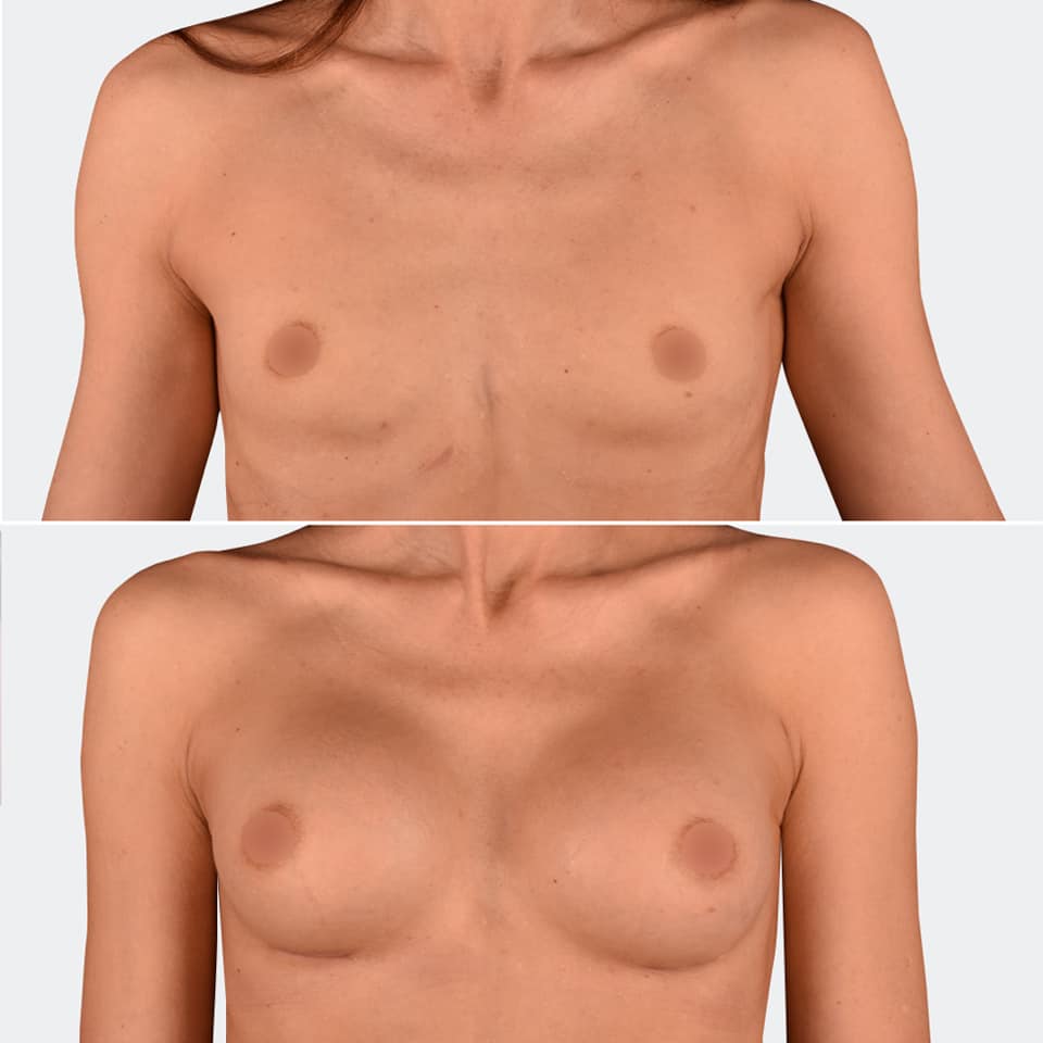 Фото до и после Маммопластика (увеличение груди) 11