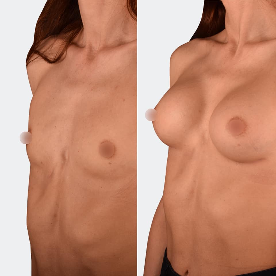 Фото до и после Маммопластика (увеличение груди) 12