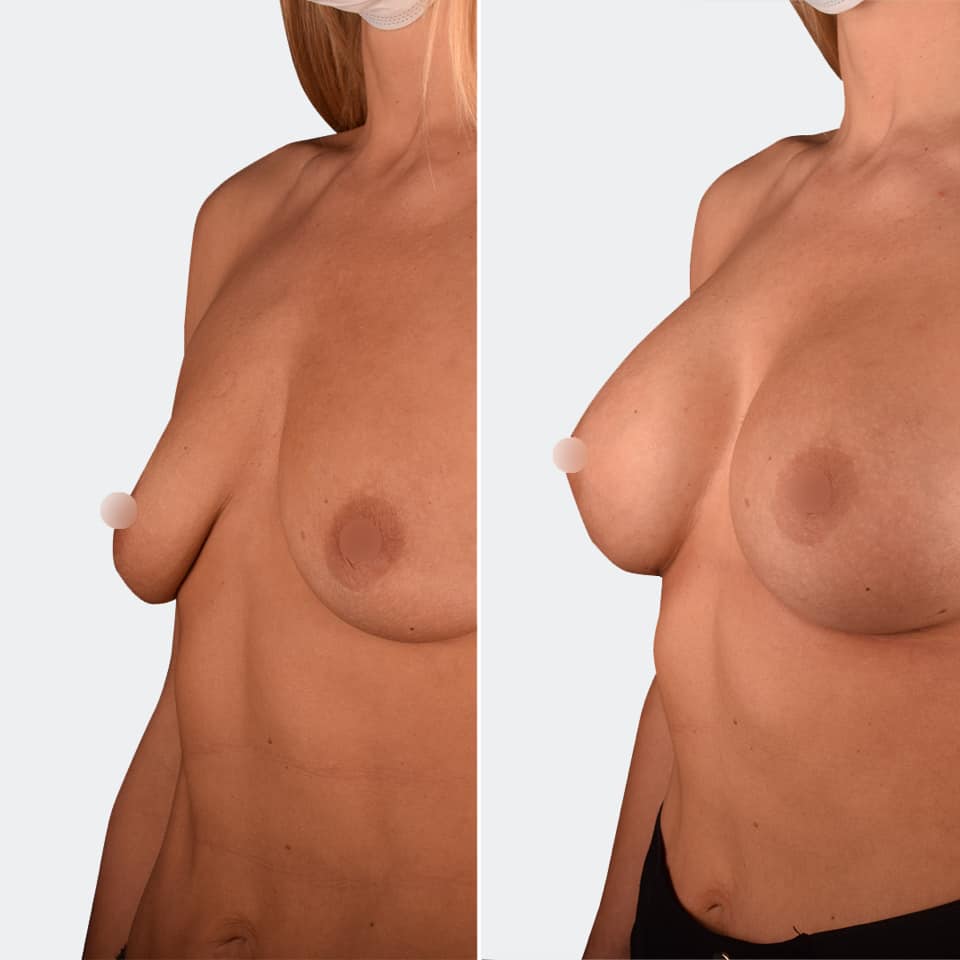 Фото до та після Мамопластика (Збільшення грудей) 3