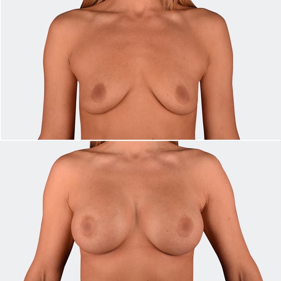 Фото до и после Маммопластика (увеличение груди) 4