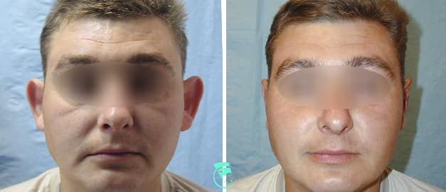 Фото до та після Пластика вух 26