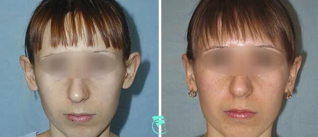 Фото до та після Пластика вух 27