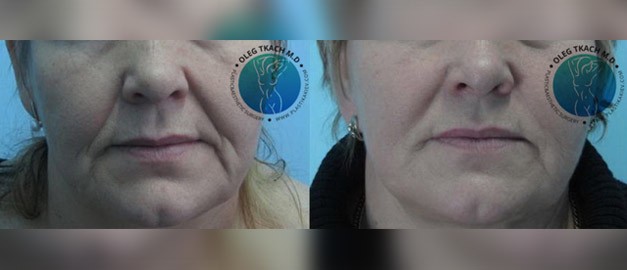 Photos before and after Filler Injections 11