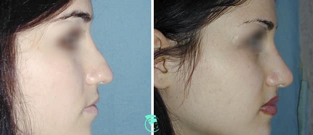 Фото до и после Ринопластика (пластика носа) 45