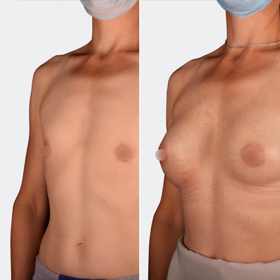 Фото до та після Мамопластика (Збільшення грудей) 6