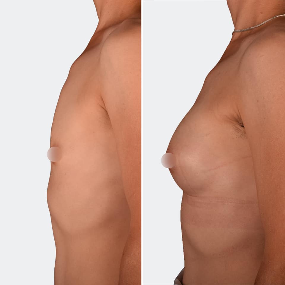 Фото до и после Маммопластика (увеличение груди) 7