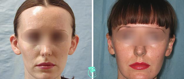 Фото до та після Пластика вух 29