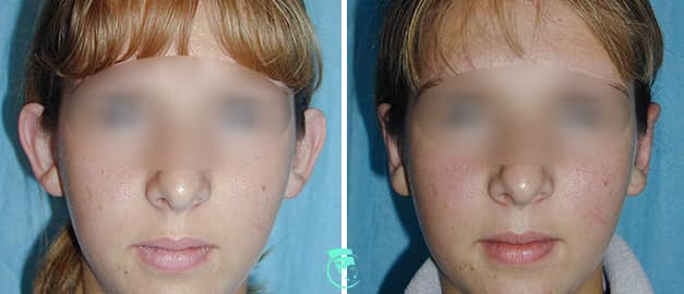 Фото до та після Пластика вух 12