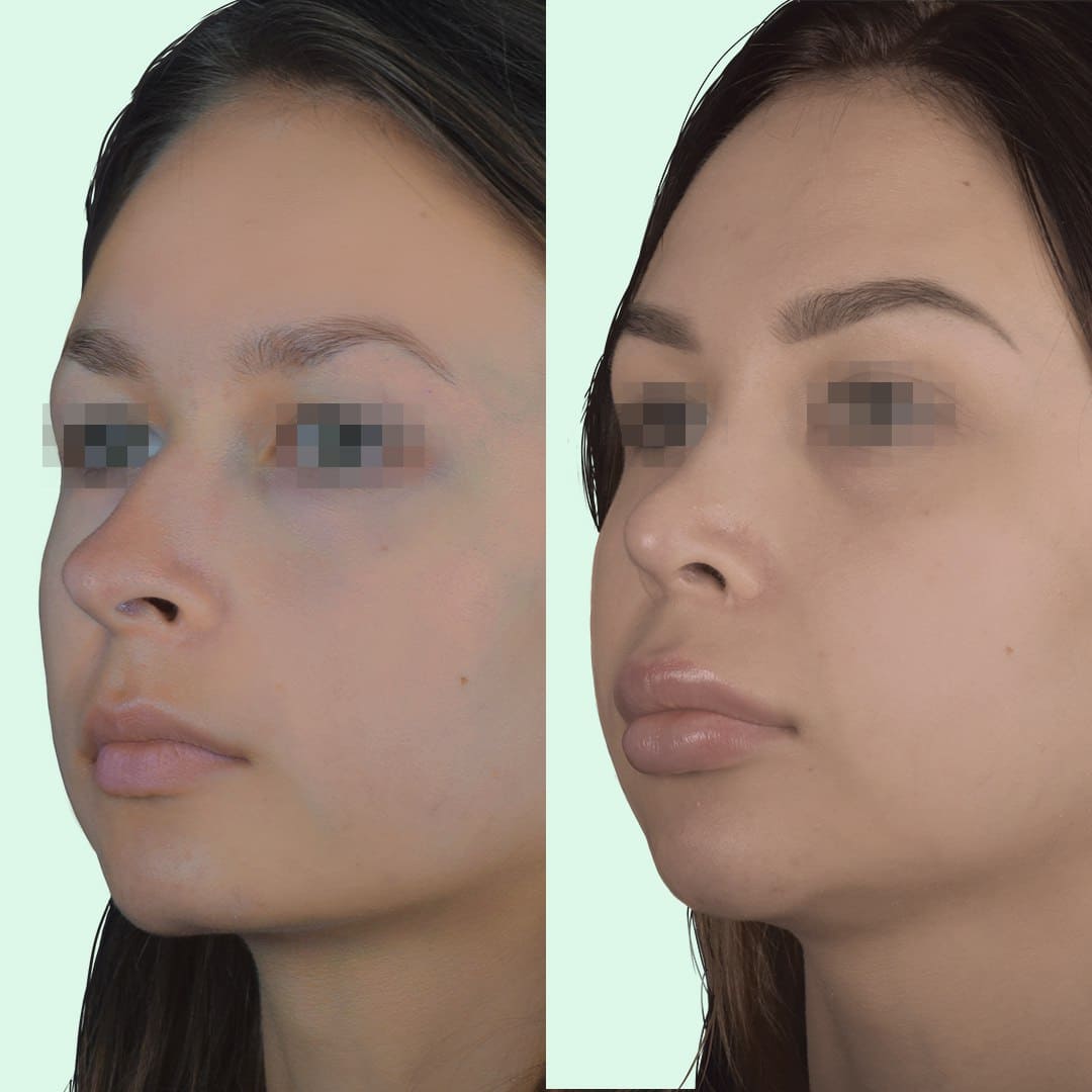 Фото до и после Ринопластика (пластика носа) 16