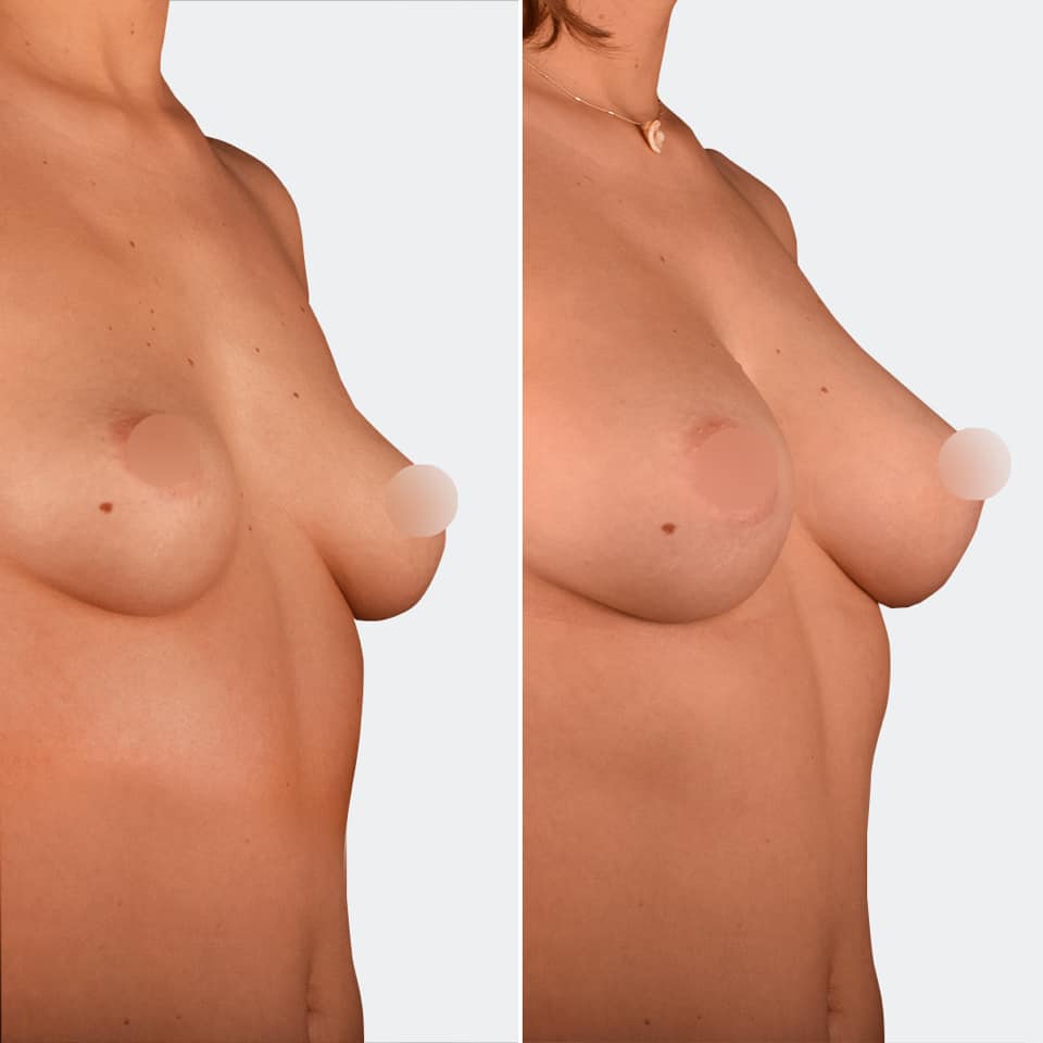 Фото до и после Липофилинг груди 2