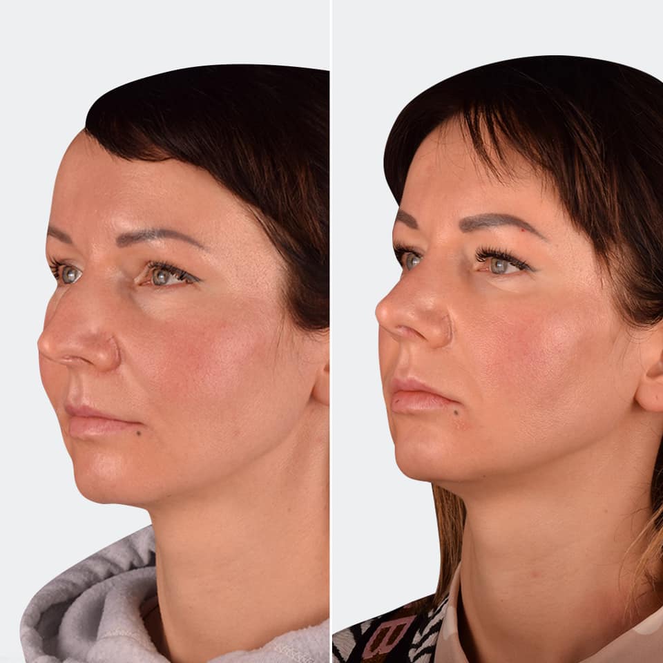 Фото до та після Ринопластика (пластика носа) 2