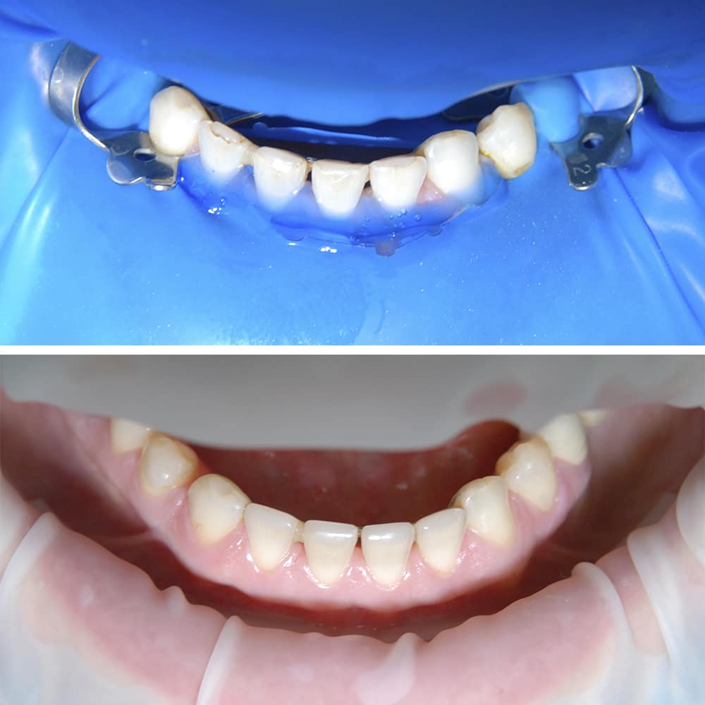 Фото до и после Терапевтическая стоматология 2