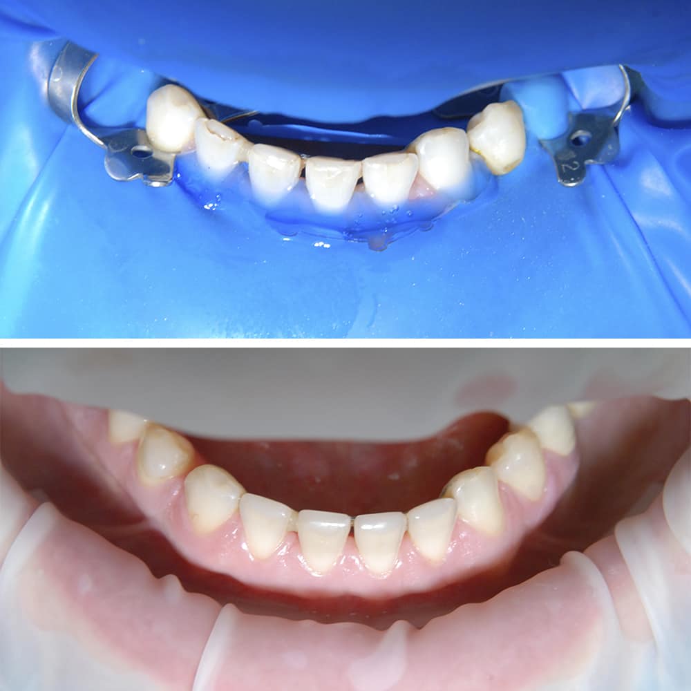 Photos before and after Therapeutic dentistry 2