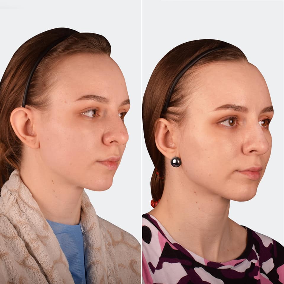 Фото до та після Пластика вух 2