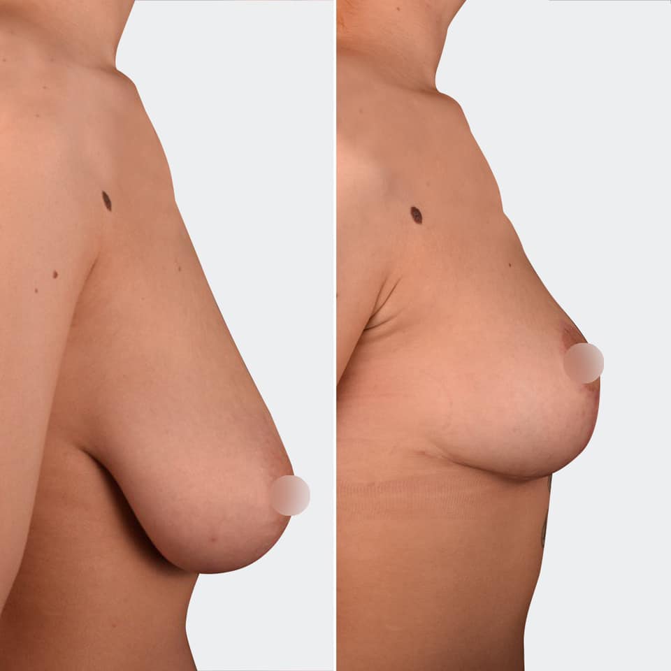 Фото до и после Уменьшение груди 2