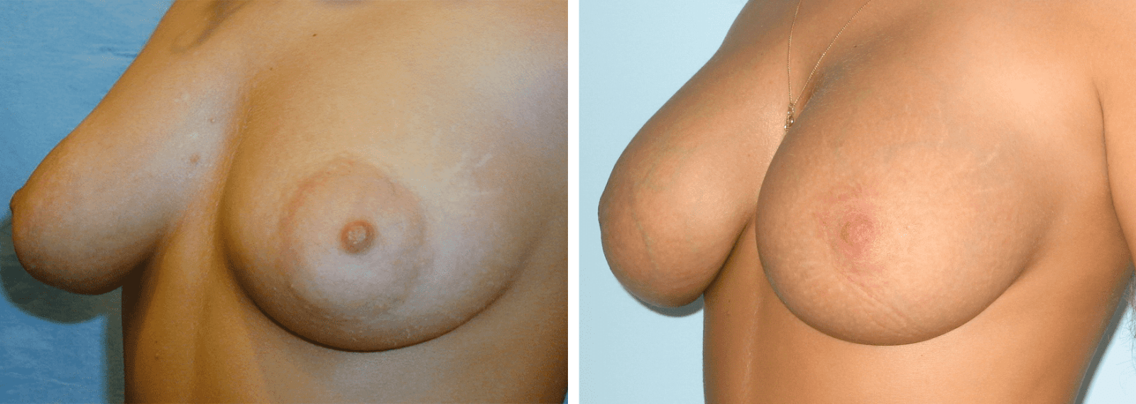 Photos before and after Nipple Correction/Areola correction 2