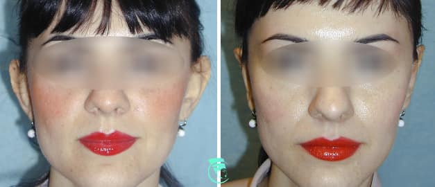 Фото до та після Пластика вух 30