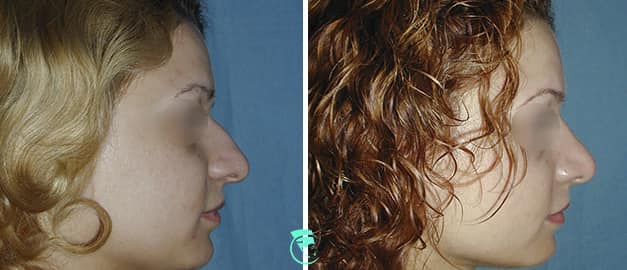 Фото до и после Ринопластика (пластика носа) 47