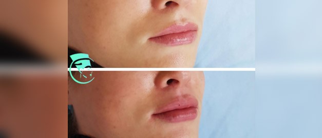 Photos before and after Filler Injections 1