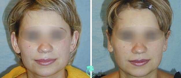 Фото до та після Пластика вух 32