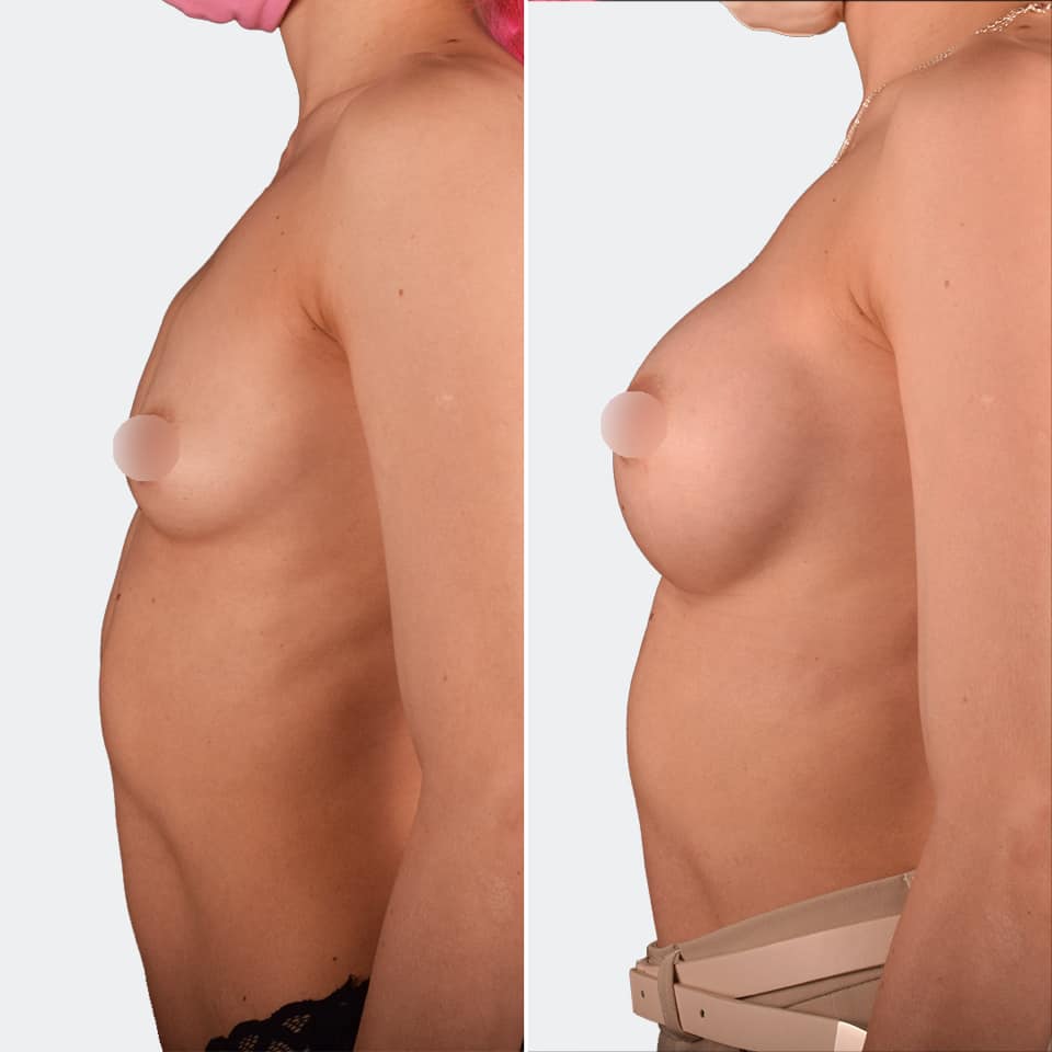 Фото до и после Маммопластика (увеличение груди) 17