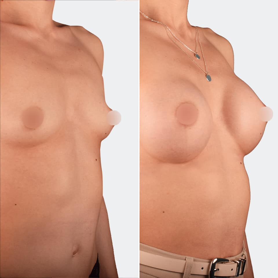 Фото до и после Маммопластика (увеличение груди) 16