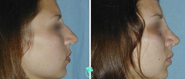 Фото до и после Ринопластика (пластика носа) 50