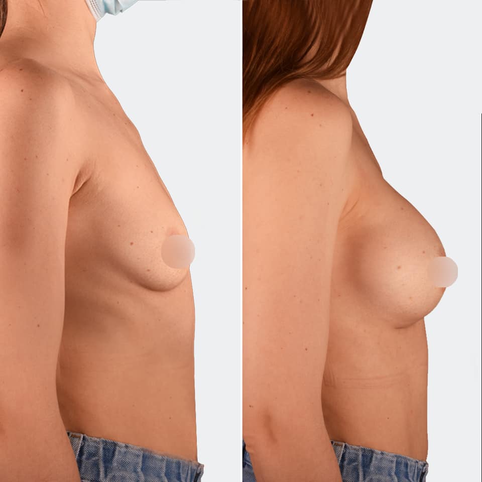 Фото до и после Маммопластика (увеличение груди) 19